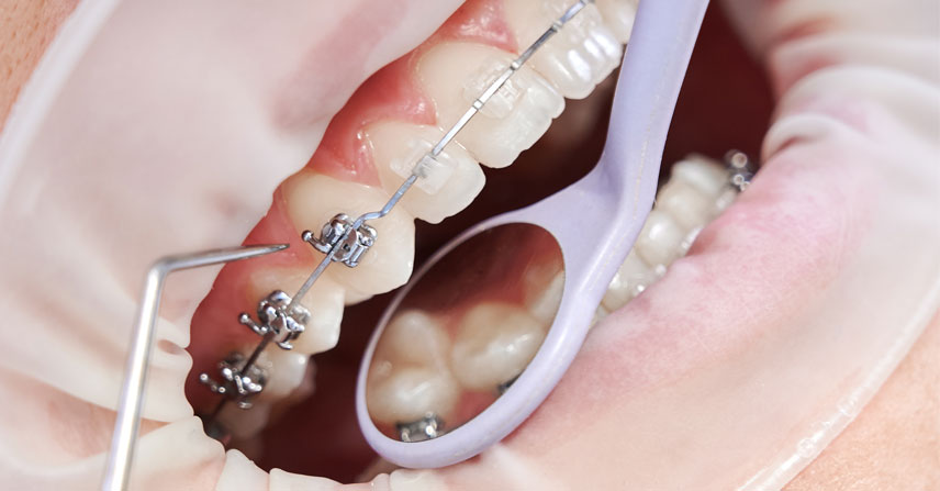 Braces & Implants at Jamnagar