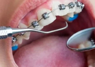 Braces