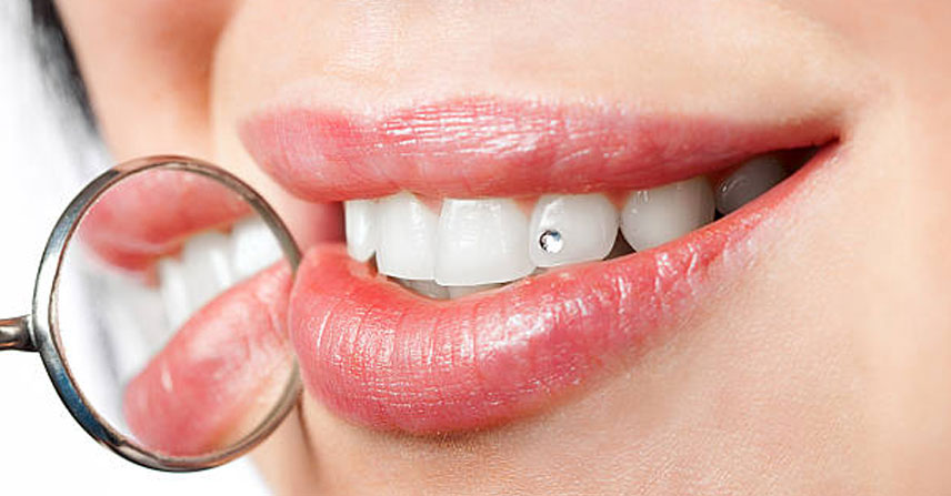 Dental Jewellery at Jamnagar