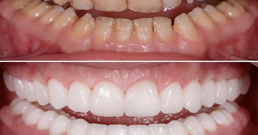 Full Mouth Rehabilitation at Jamnagar