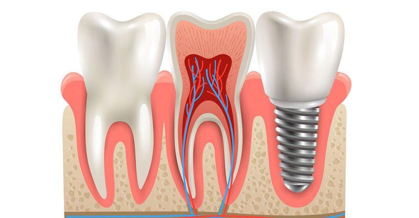 Root Canal at Jamnagar