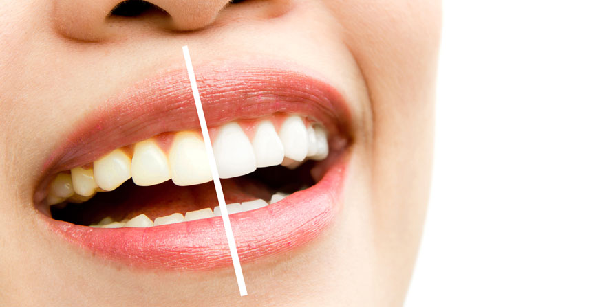 Teeth Whitening at Jamnagar