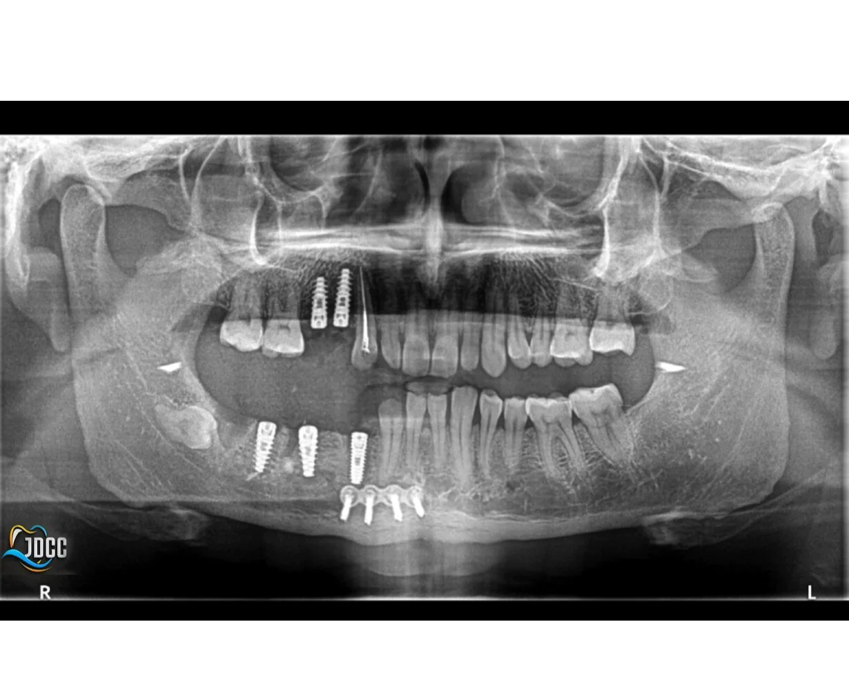 Dental Implant in jamnagar