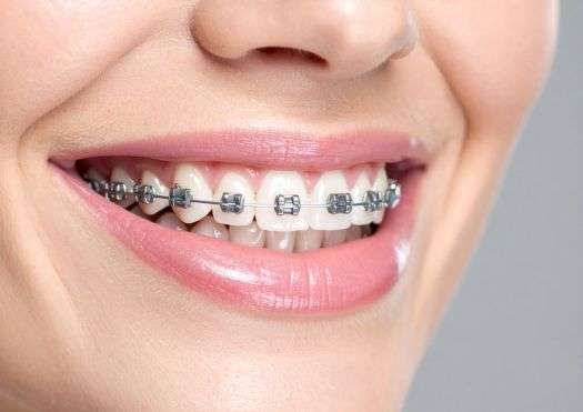 Jamnagar Dental Care Center Straighten Your Smile: Orthodontic Braces in Jamnagar