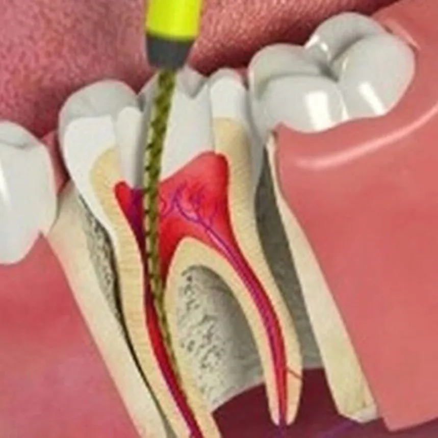 root canal treatment in jamnagar