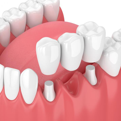 implant dentist in jamnagar