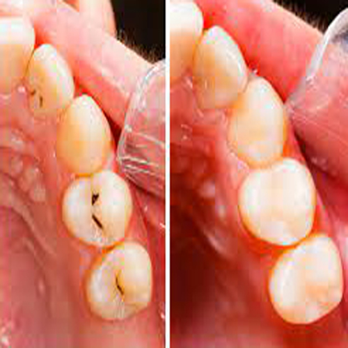 tooth filling in jamnagar