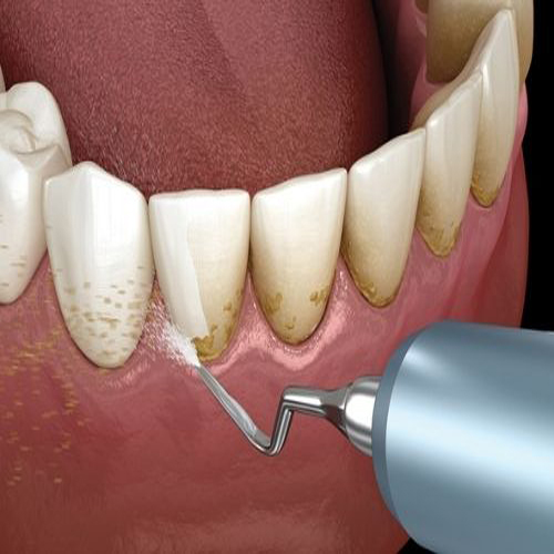 teeth whitening dentist in jamnagar